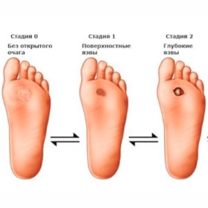 Симптомы диабета